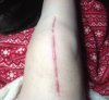 [Bonesmart.org] The girl with the two fake knees