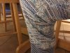 [Bonesmart.org] New Pain one year post op RTKR?