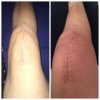 [Bonesmart.org] New Pain one year post op RTKR?
