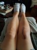 [Bonesmart.org] Mireille's RTKR 4 months