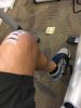 [Bonesmart.org] 10 Days Post Op.....so far, so good