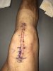 [Bonesmart.org] 10 Days Post Op.....so far, so good