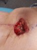 [Bonesmart.org] The girl with the two fake knees
