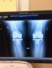 [Bonesmart.org] 15month update....finally normal