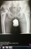 [Bonesmart.org] Hip problems without groin pain?