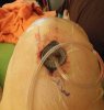 [Bonesmart.org] Right TKR is done