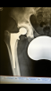 [Bonesmart.org] 8wks post op - more pain than before<<