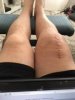 [Bonesmart.org] Concerned with slow, painful recovery<