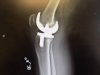 [Bonesmart.org] Concerned with slow, painful recovery<