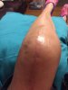 [Bonesmart.org] My LTKR journey continues to RTKR<