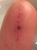 [Bonesmart.org] My LTKR journey continues to RTKR<