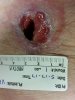 [Bonesmart.org] Right TKR is done