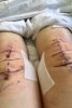 [Bonesmart.org] SusieShoes' New Knees