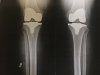 [Bonesmart.org] SusieShoes' New Knees