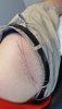 [Bonesmart.org] April 21 - finally getting a repaired hip