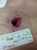 [Bonesmart.org] Right TKR is done