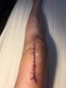 [Bonesmart.org] My LTKR journey continues to RTKR<