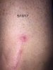 [Bonesmart.org] SusieShoes' New Knees