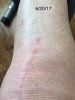 [Bonesmart.org] SusieShoes' New Knees