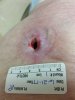 [Bonesmart.org] Right TKR is done