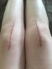 [Bonesmart.org] SusieShoes' New Knees
