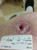 [Bonesmart.org] Right TKR is done