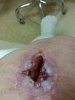 [Bonesmart.org] Right TKR is done