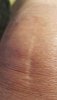 [Bonesmart.org] 2017 August Hot Shots - Are you having knee surgery in August?