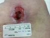 [Bonesmart.org] Right TKR is done
