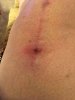 [Bonesmart.org] One year kneeversary