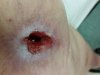 [Bonesmart.org] Right TKR is done