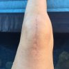 [Bonesmart.org] kmak's TKR recovery thread