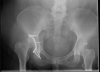[Bonesmart.org] Compression stockings
