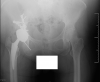[Bonesmart.org] Compression stockings