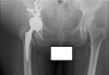 [Bonesmart.org] Compression stockings