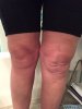 [Bonesmart.org] kmak's TKR recovery thread