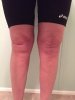[Bonesmart.org] kmak's TKR recovery thread