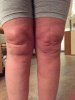 [Bonesmart.org] kmak's TKR recovery thread