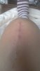 [Bonesmart.org] New left knee