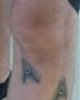 [Bonesmart.org] Buckbuck’s new knee<