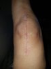 [Bonesmart.org] New left knee