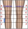 [Bonesmart.org] Incision opened when staples removed<