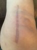 [Bonesmart.org] SusieShoes' New Knees