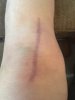 [Bonesmart.org] SusieShoes' New Knees