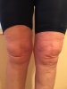 [Bonesmart.org] kmak's TKR recovery thread
