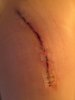 [Bonesmart.org] Janet’s recovery - 2nd hip done