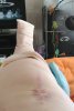 [Bonesmart.org] The girl with the two fake knees