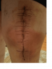 [Bonesmart.org] Thumper's new knee  21 Mar 2018