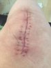 [Bonesmart.org] Eeek’s recovery thread.
