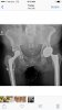 [Bonesmart.org] Life After SCaprae